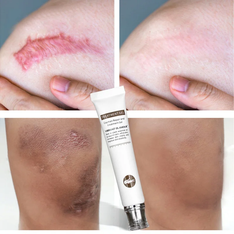 

Crocodile Repair Scar Cream Removal Scar Acne Treatment Marks for Face Body Pigmentation Corrector Skin Care