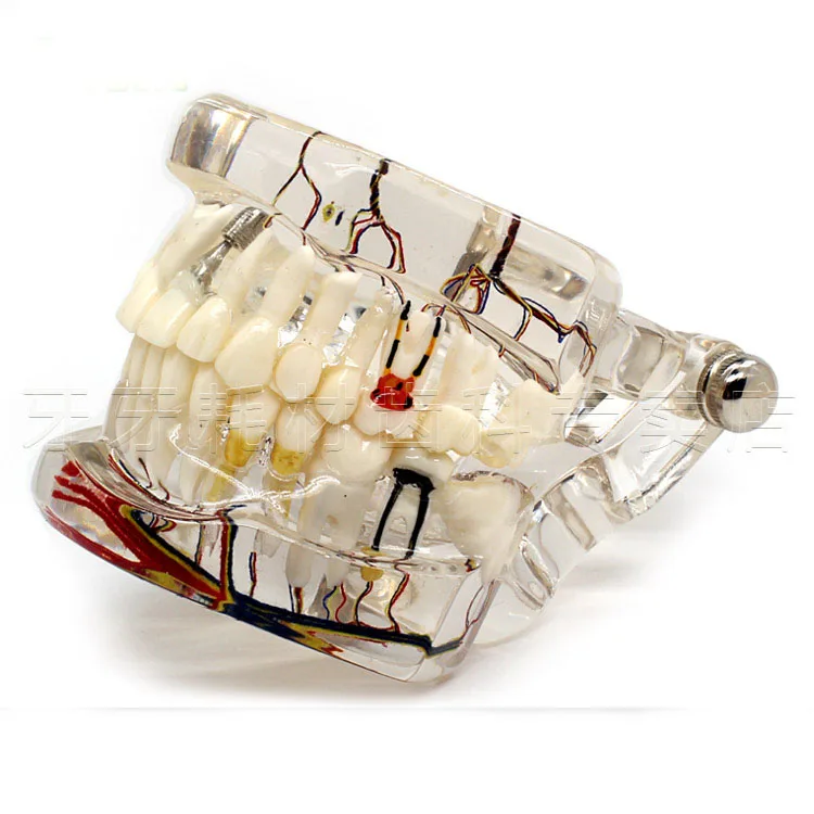 Dental model with nerve adult pathology teeth model doctor patient ...