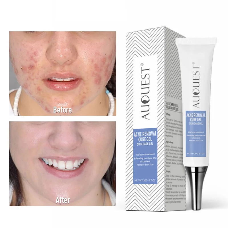 

Blackhead Moisturizing Whitening Oil-control Reduce Pores Acne Facial Treatment Cream Anti Scar Removal Pimple Skin Care TSLM1