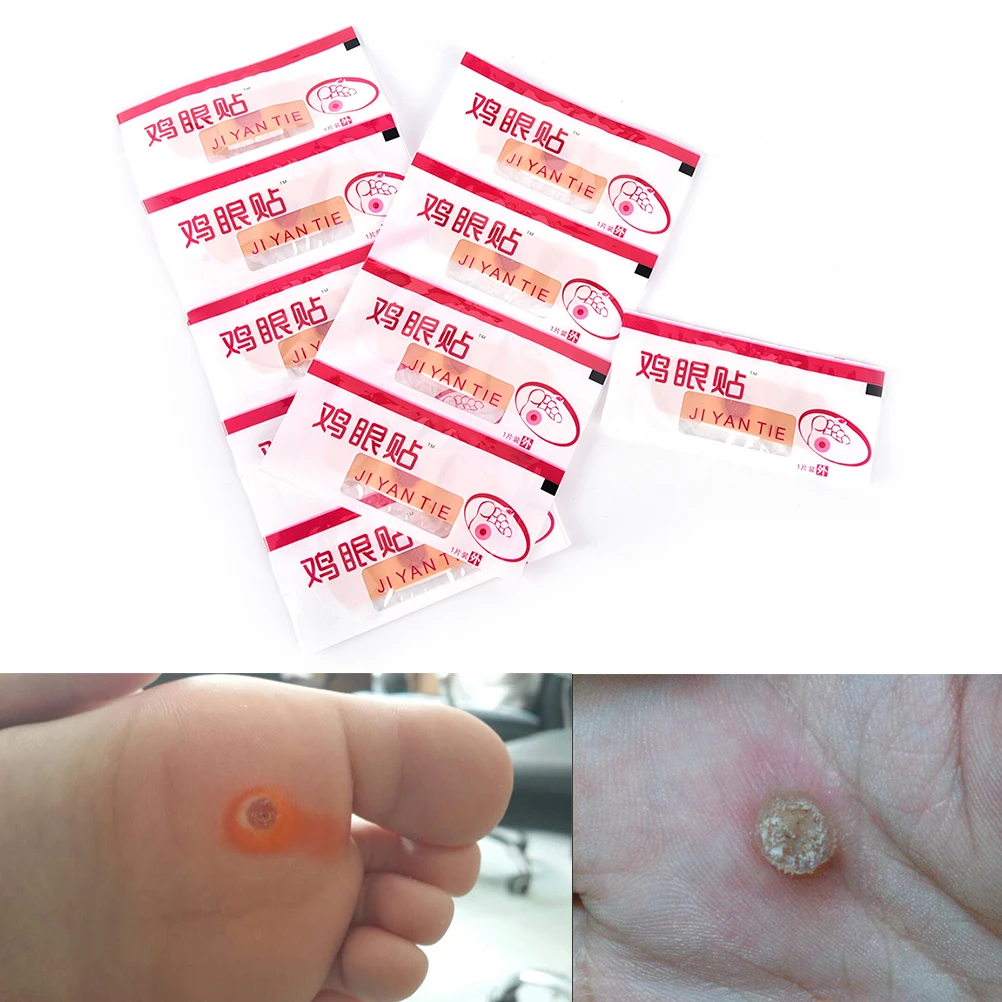 

10PCS/Lot Hand Foot Corn Cocoon Sticker Chinese Traditional Medical Remove Hand Corn Dead Skin Pedicure