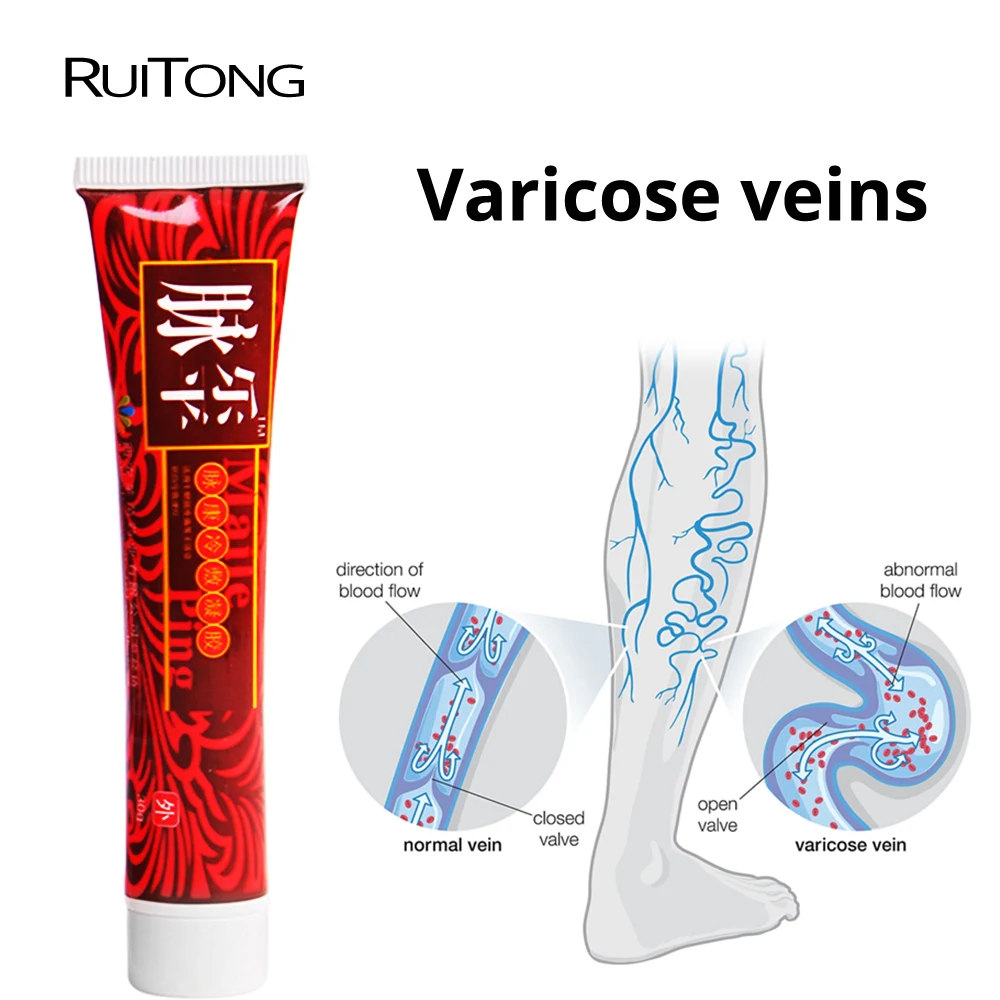 

RuiTong Varicose Veins Cream Professional treatment Vasculitis Phlebitis Spider Veins Pain Varicosity Angiitis Medical Plaster