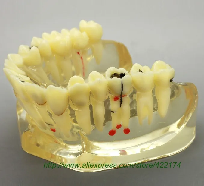 2 раза взрослых патологий модель зубной зуб зубы анатомические Анатомия Стоматологическая модель