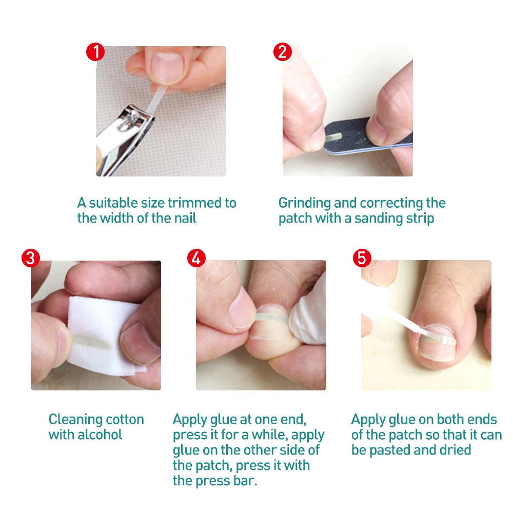 10pcs Toe Nail Ingrown Correction Sticker Patch Foot Care Paronychia Correction File Elastic Patch Corrector Treatment C1510