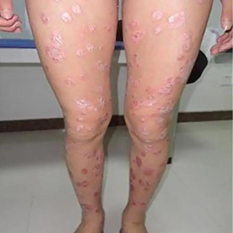 Dropshipping-Zudaifu-Skin-Psoriasis-Cream-Dermatitis-Eczematoid-Eczema-Ointment-Treatmen-Psoriasis-Cream-Skin-Care-Cream