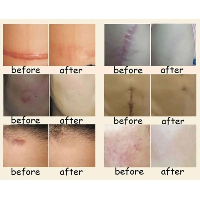 NEW HOT Nuobisong Facial Scar Removal Cremas Facial Spots Treatment Whitening Face Cream Stretch Marks moisturizing