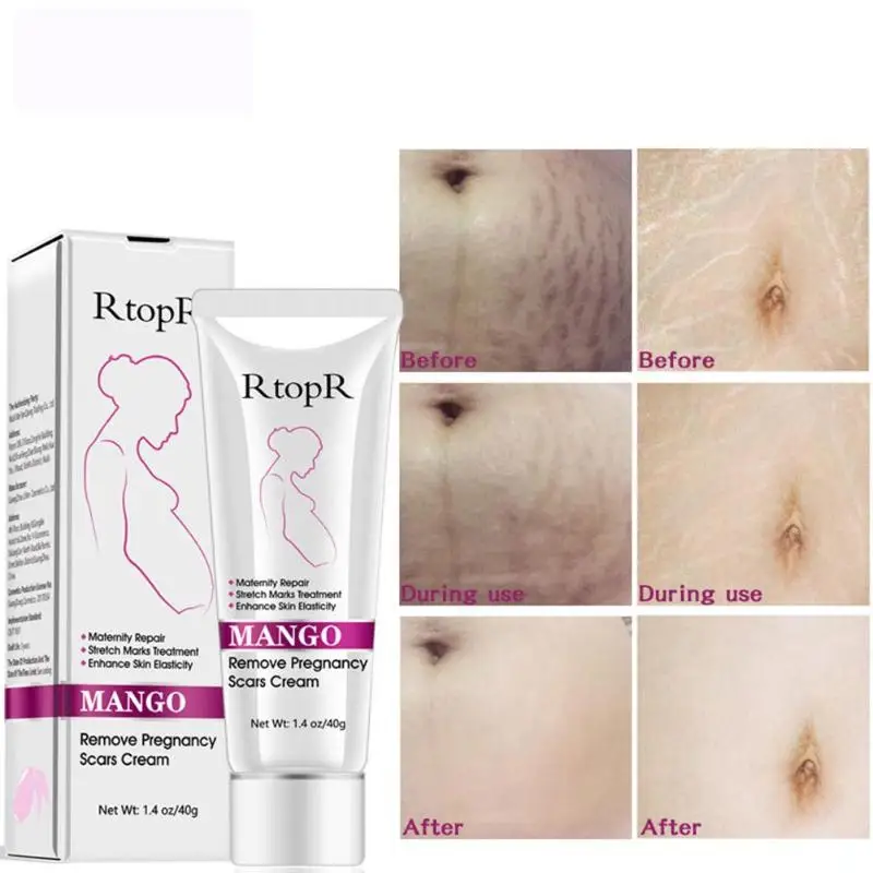 

Mango Remove Pregnancy Acne Scars Removal Cream Moisturizing Cream Remove Stretch Marks Maternity Repair Anti-Aging Anti Winkles