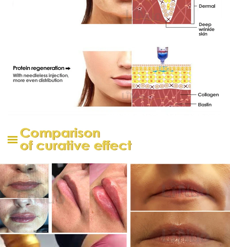 Cabeça da Ampola da Agulha para Hyaluron Caneta de Alta Remoção do Enrugamento Seringa de Água Pces Seringa Medicina Arma Hyaluron Pressão 50 0.3ml ou 15 hyaluron caneta de alta pressão remoção do enrugamento seringa de água