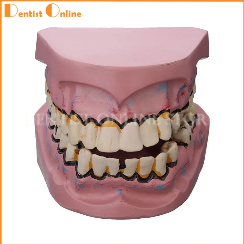 

1PC Dental Implant Disease Teeth Model Smoking Decay Caries Tooth Model Denture For Dentist Medical Science Teaching Study