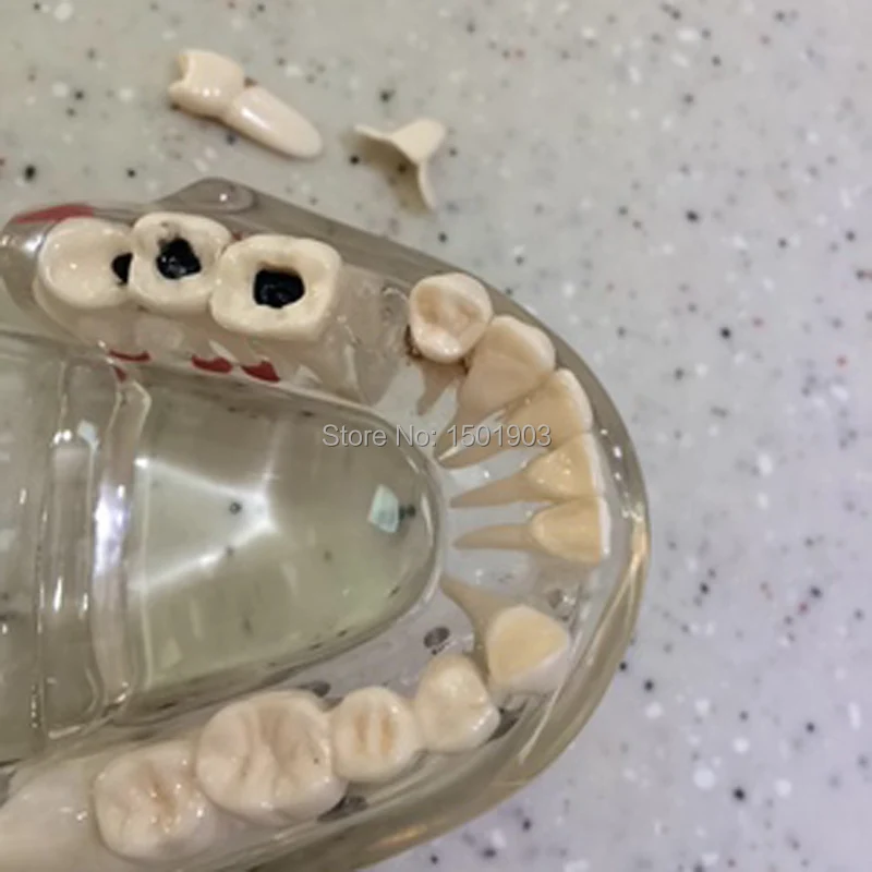  Dental materials denture model Oral removable dental pathological model Tooth Study Teach Model - 32795839251