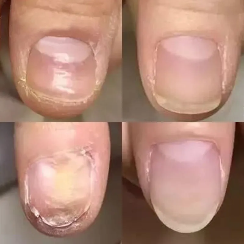 Natural Plant Antibacterial Nail Treatment Cream Nails Fungus Repair Toe Nail Care Cream Effective Onychomycosis Treatment Cream