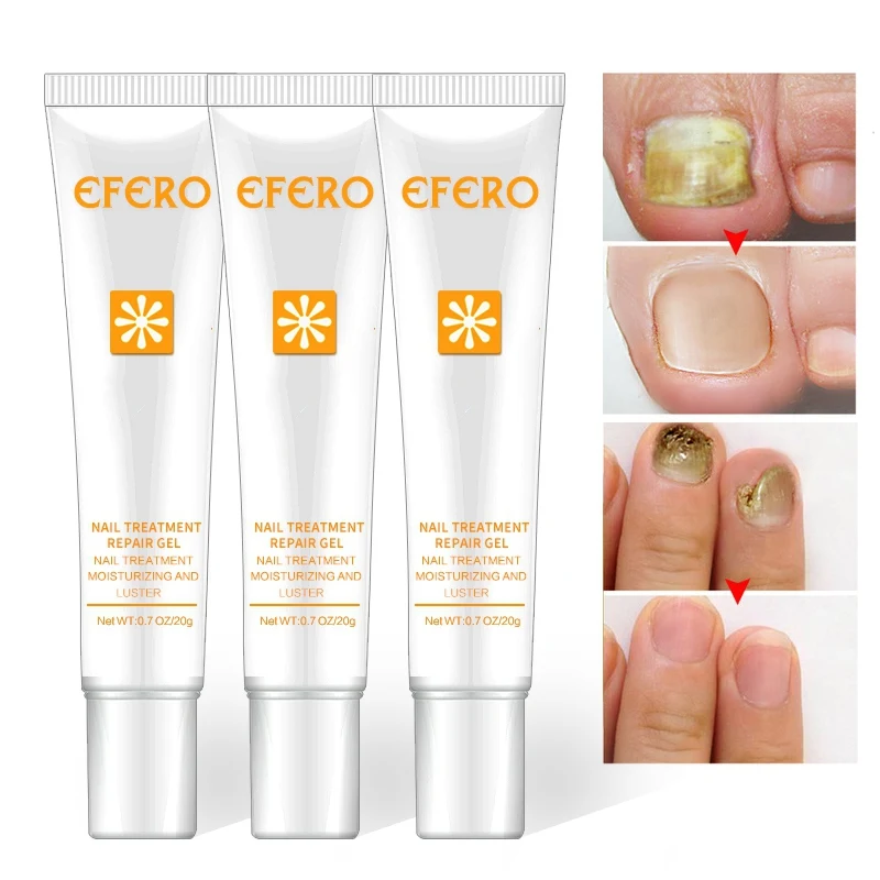 20g Nail Care Tools Anti Toenail Fungus Nails Nourishing Cream Nail Treatment Hand Foot Protector Nails Repair Serum