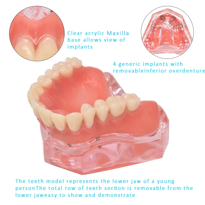 Стоматологическая Overdenture Зубы Модель съемная внутренняя челюсти нижние зубы модель челюсти с имплантатов для зуба обучения, изучения