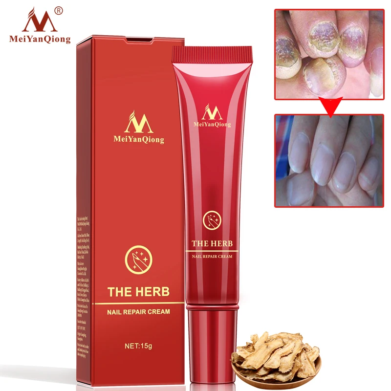 

MeiYanQiong 1Pcs Herbal Anti Fungal Nail Treatment Cream Toe Nail Fungus Treatment Onychomycosis Paronychia Toe Nail Infection