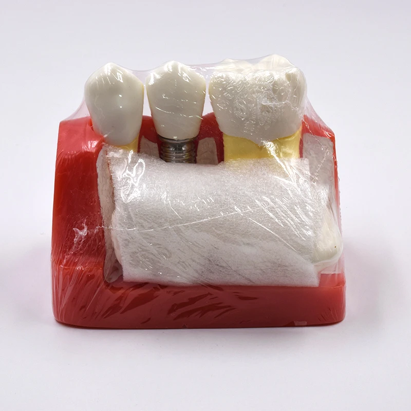 

OSLDent Dental Demonstration Teeth Model Implant Analysis Crown Bridge 1 Pcs Tooth Study lab equipment