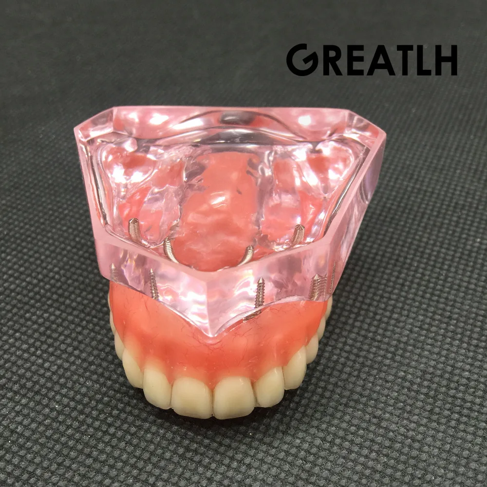 Dental Overdenture Superior with 4 Implants Demo Model Dental Teaching Study Demonstrate Model #6001 01 цена Dental Overdenture Superior with 4 Implants Demo Model Dental Teaching Study Demonstrate Model #6001 01 цены онлайн