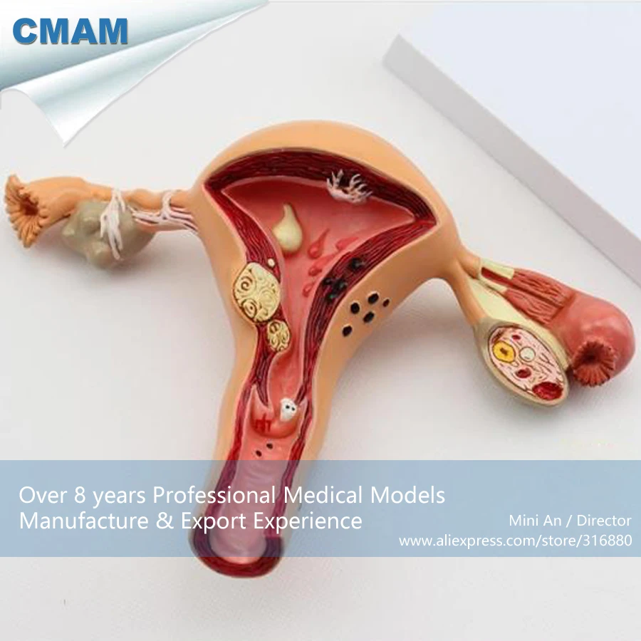 CMAM/12441 патологическое маточное влагалище, мочеполовой медицинский обучение анатомическая модель