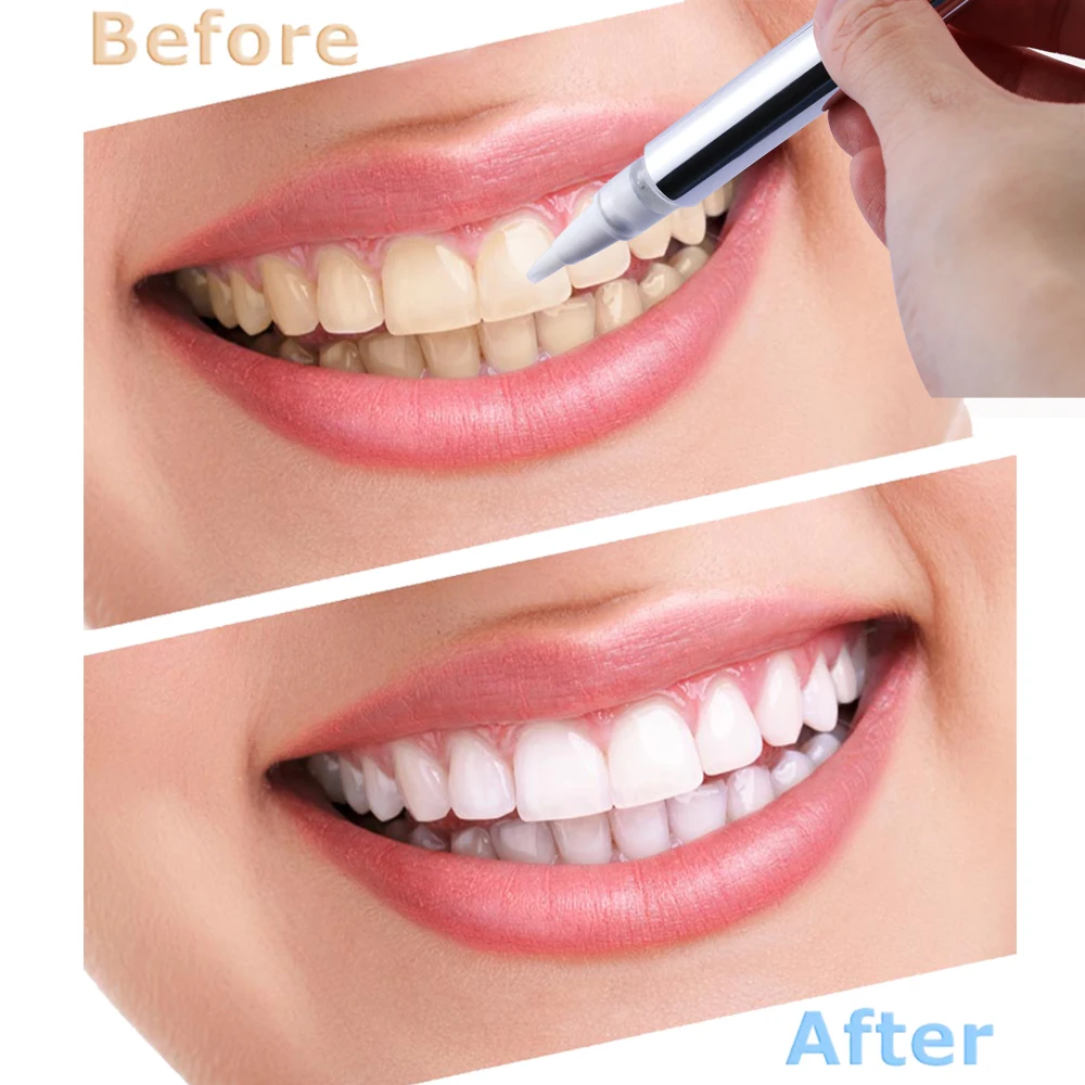 1PCs Hot Effective Teeth Whitening Pen Tooth Gel Whitener Bleach Stain