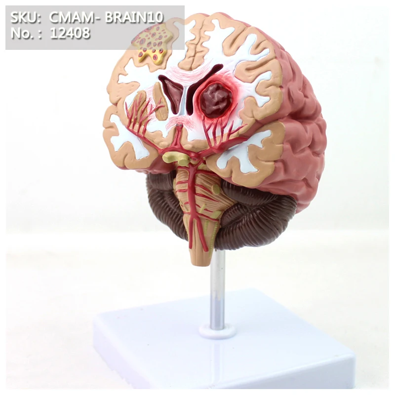 CMAM-BRAIN10 Медицинский Анатомический Мозг Модель Болезни, анатомические Модели Мозговой Артерии Порок