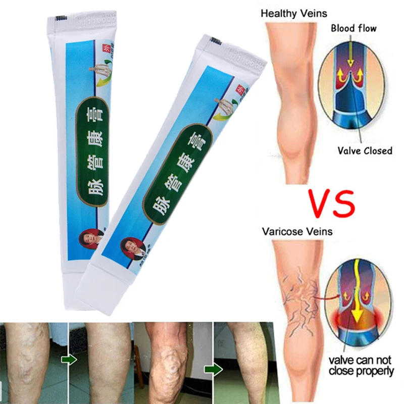 

No box ! Chinese natural herbal medicine for treating varicose vascular inflammation massage cream cure varicose vein ointment