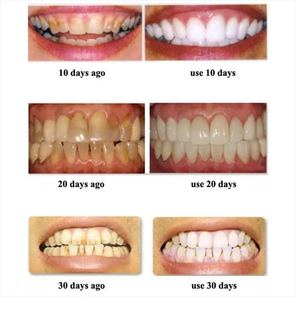 28 шт./14 пар 3D белые гелевые отбеливающие полоски для зубов, инструменты для стоматолога, полоски для гигиены полости рта, полоски для накладных зубов, виниры Smi