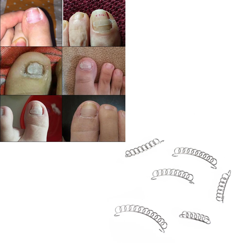 

6 PCs/Box Toenail Correction Ingrown Wire Fixer Paronychia Acronyx Onyxis Bunion Nail Recover Foot Care Tool Nail Clipper Set