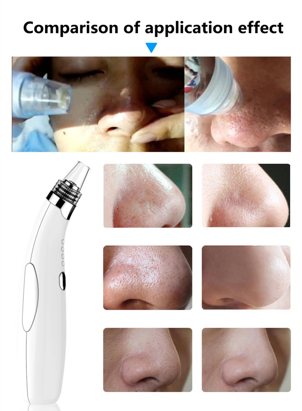 Blackhead-Remover (14)