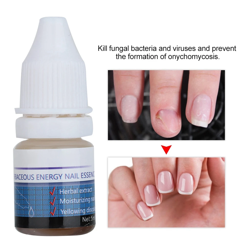 5 мл лечение Leuconychia мощный антигрибковый травяной экстракт растений Уход за ногтями гель Ногти Уход за ногтями