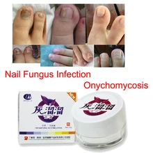 Nail Fungus Treatment Onychomycosis Paronychia Toe Nail Slits Infection Finger Ointment Chinese Herbal Products