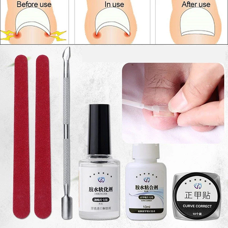 

Basic Foot Care Tool Set Ingrown Toenail Straighten Clip Curved Patch Lifter Fixer Toe Nail Recover Correction Tool Dropship