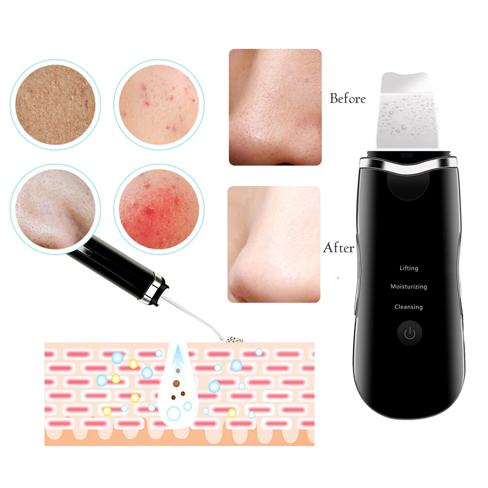 

Ultrasonic Skin Scrubber Facial Deep Face Cleansing Peeling Tools Electric Dead Skin Remover Ultrasound Blackhead Remover