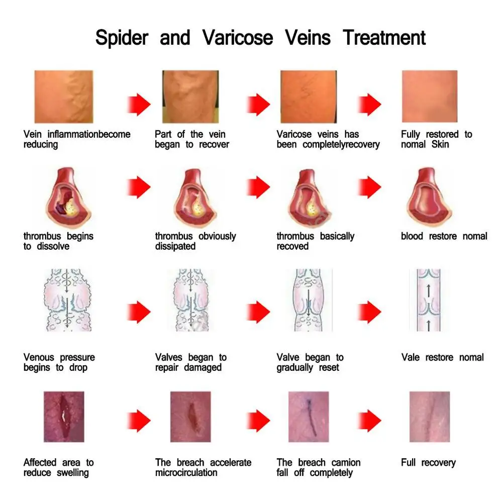1 шт варикозное расширение вен лечение васкулита флебита ангиит Мороз Нижние конечности воспаление кровеносный сосуд тухлые ноги крем
