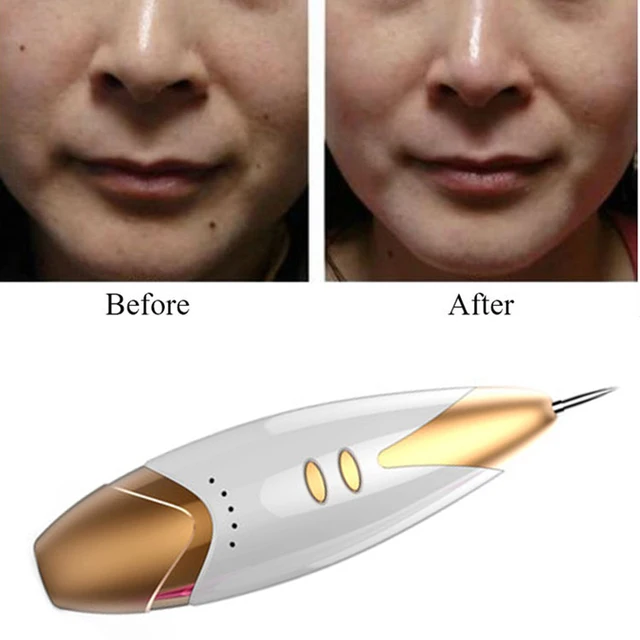 neue laser freckleabbau maschine haut maulwurf entfernung neue laser freckleabbau maschine haut maulwurf entfernung