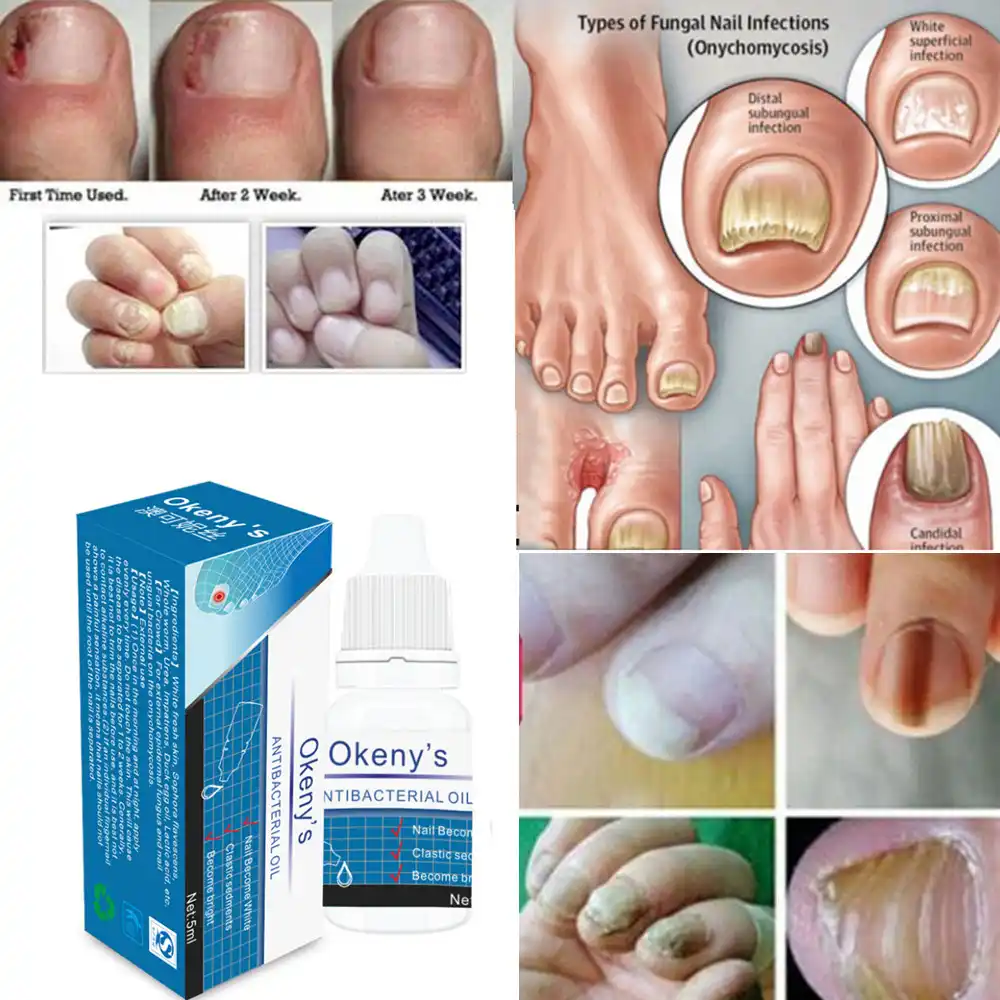 Thumbnail Infection Treatment fungal nail repair liquid treatment pen onychomycosis paronychia anti fungal nail infection 2018 step 25