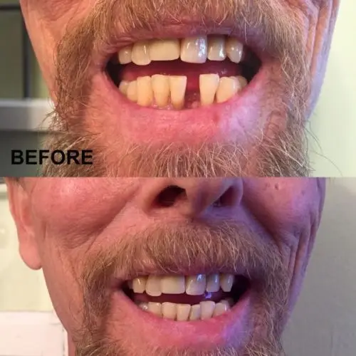 

Dental Veneers For Teeth False Smile Veneers Removable Veneers On Teeth Instant Smile Temporary Tooth Fix Kit Natural Color