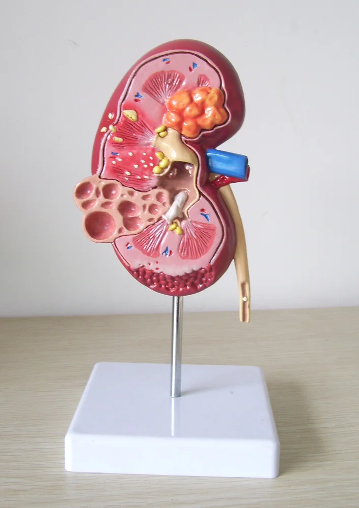 

1Pc Kidney Anatomical Model 2- sided Diseased Anatomy Medica l glomerulus kidney nephron renal Anatomical Model