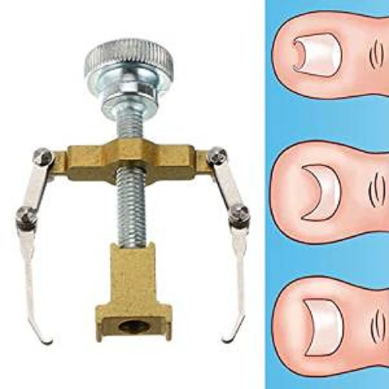 

1Pcs Ingrown Toe Nail Correction Tool Fixer Recover Toe Paronychia Nail Brace Tools Ingrown Toenails Pedicure Tool #240389
