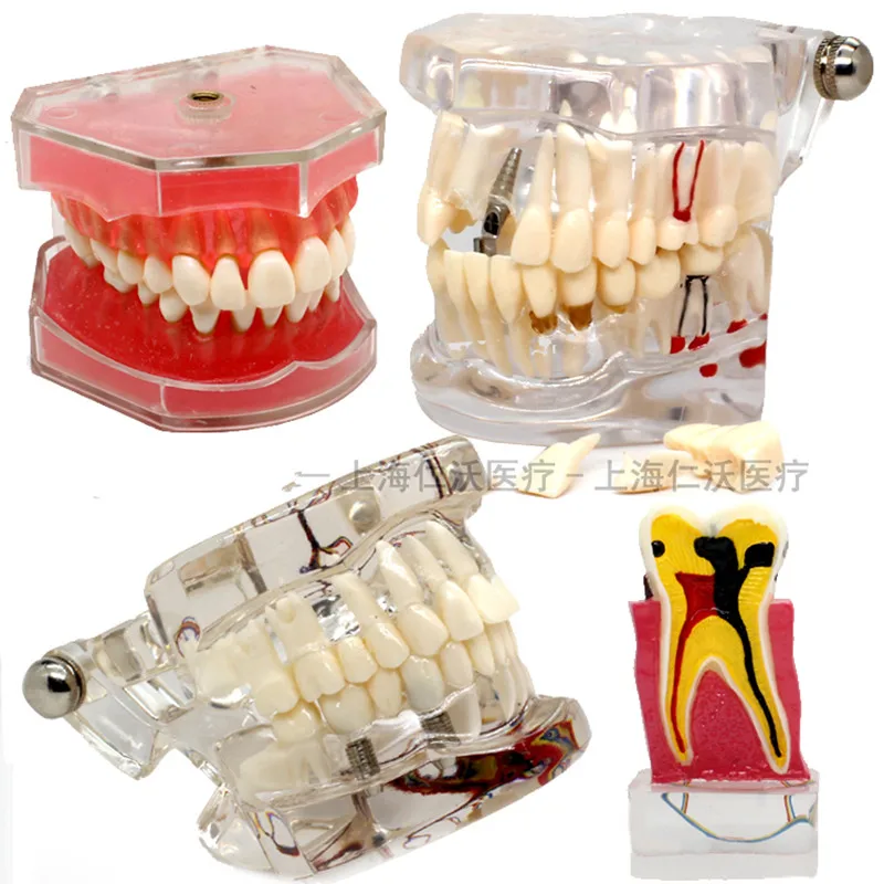 Usados para Ensino e Material de Hospital Material de Dentista Vários Modelos Dentes Dentários São 5 Modelo de Ensino Dental