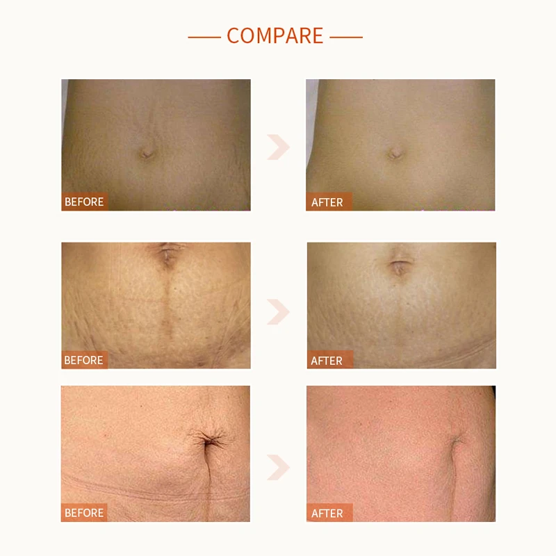 vitamin e lotion for stretch marks