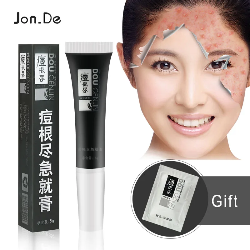 

Anti Acne Cream acne scars mark remover skin lightening face cream whitening to remove dark spots tee tree oil salicylic acid
