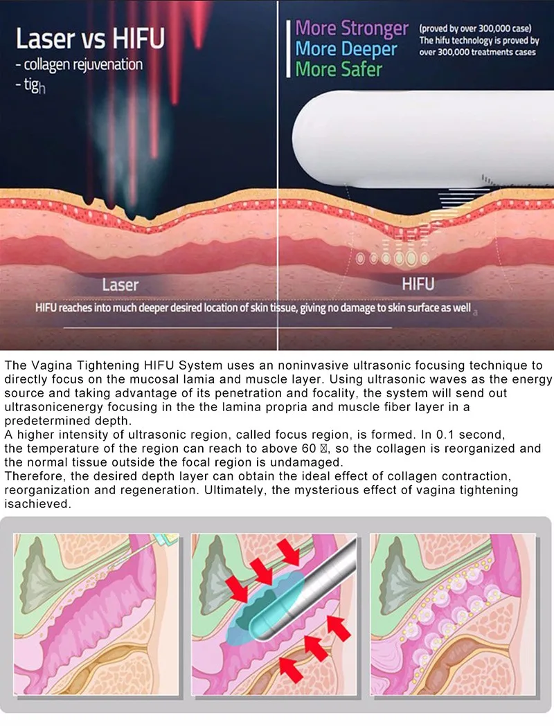 Новая технология HIFU затягивающая вагинальная затягивающая машина прибор красоты для использования в клинике