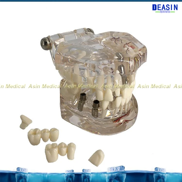 Новая модель зубного имплантата зубы с нервом прозрачная патологическая модель ремонта обучающая демонстрационная модель