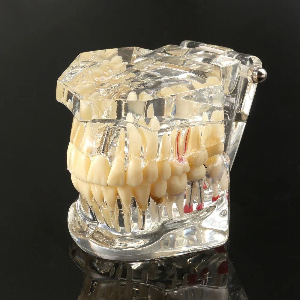Kopen 1 stuk Volwassen Dental Resin Restauratie Model Tanden Studie Model Tandarts Gereedschap Tandheelkunde Laboratorium Transparant Model