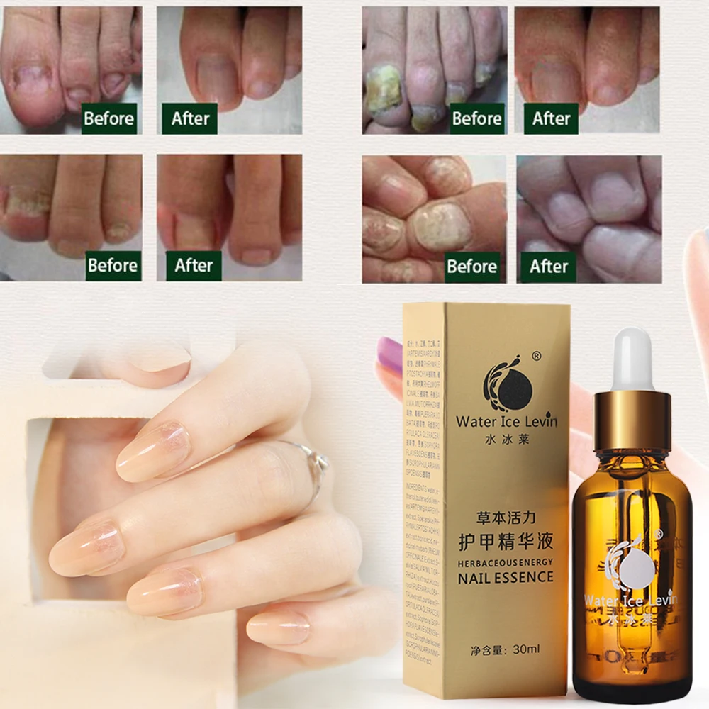 30ml Finger Toe Repair Essence Bad Nail Removal nail Care Oil Feet Nail Care Beauty Manicure Tools