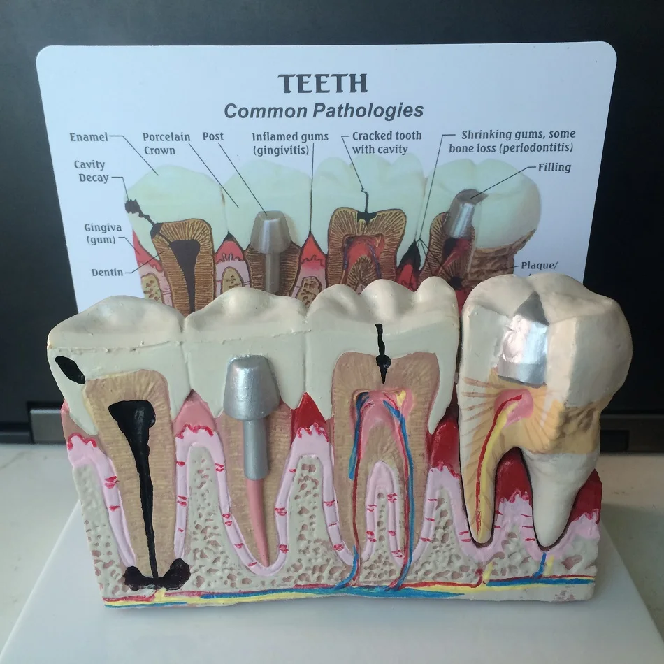 Dental teeth common pathologies model teaching model ,Tooth Dentist for