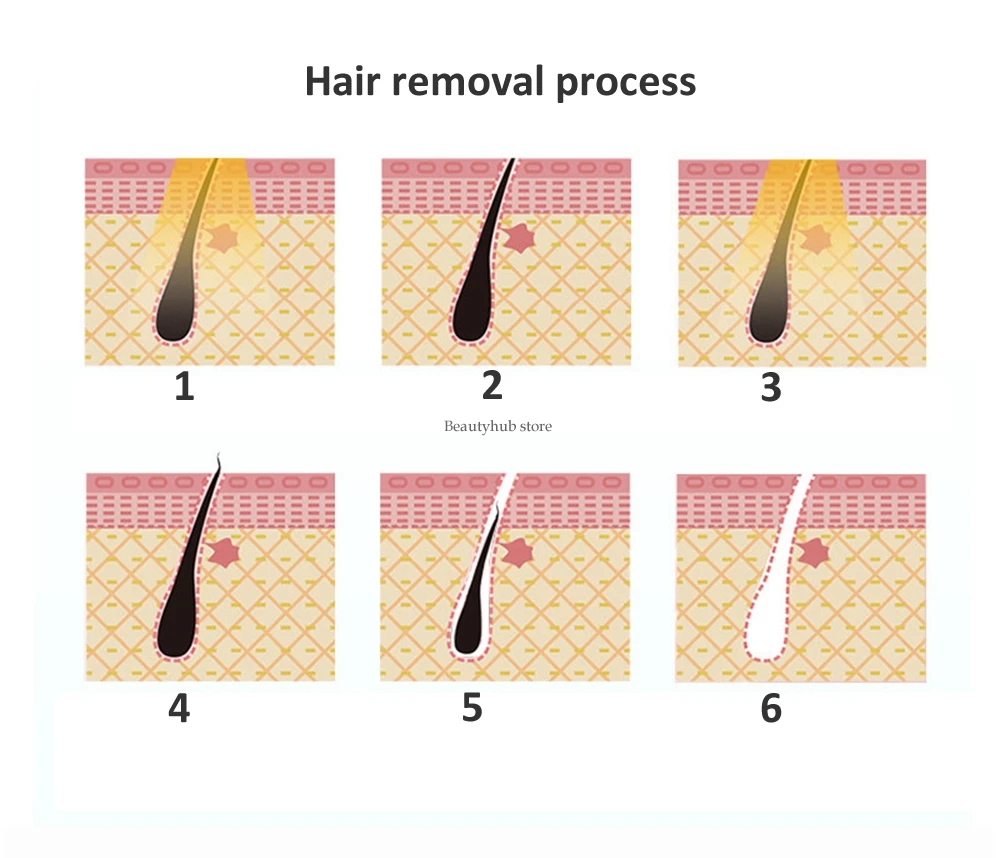 Эпиляция ли пинцет. Волосяная луковица. Эпиляция ли пинцет. Эпиляция ли пинцет. Эпиляция ли пинцет.