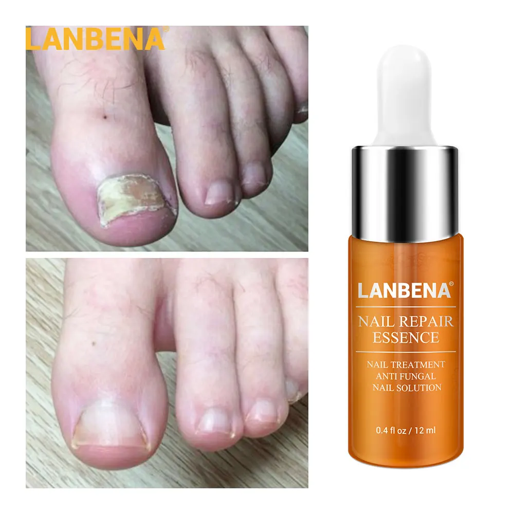 LANBENA Nail Repair Essence-Serum Fungal Nail Treatment Remove Onychomycosis Nose Tooth Nutrient Lightening Hand and Foot Care
