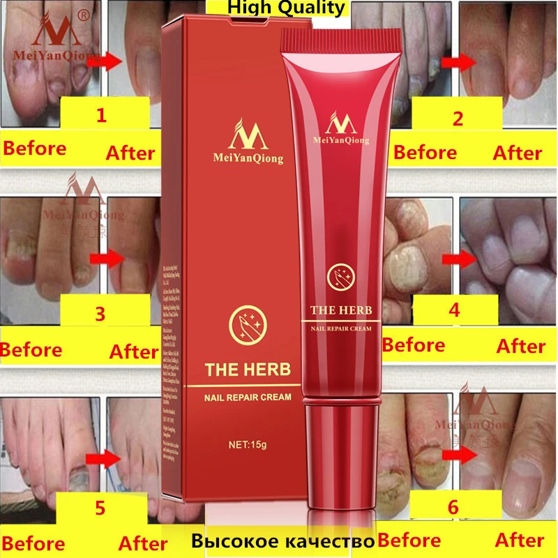 DropShipping MeiyanQiong Nail Care Herbal Nail Repair Cream Anti Fungal Nail Chinese Herbal Toe Nail Fungus Treatment