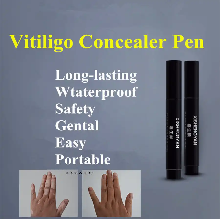 vitiligo concealer