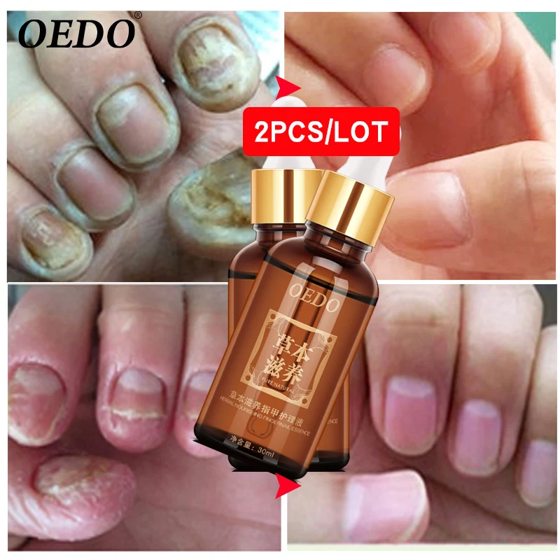 

2 tablets / batch nail care essential oil hand and foot whitening toe nail fungus to remove infected foot care bright nail gel