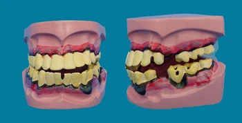 

Dental Implant Disease Teeth Model Smoking Decay Caries Tooth Model Denture for Dentist Medical Science Teaching Tooth Anatomy